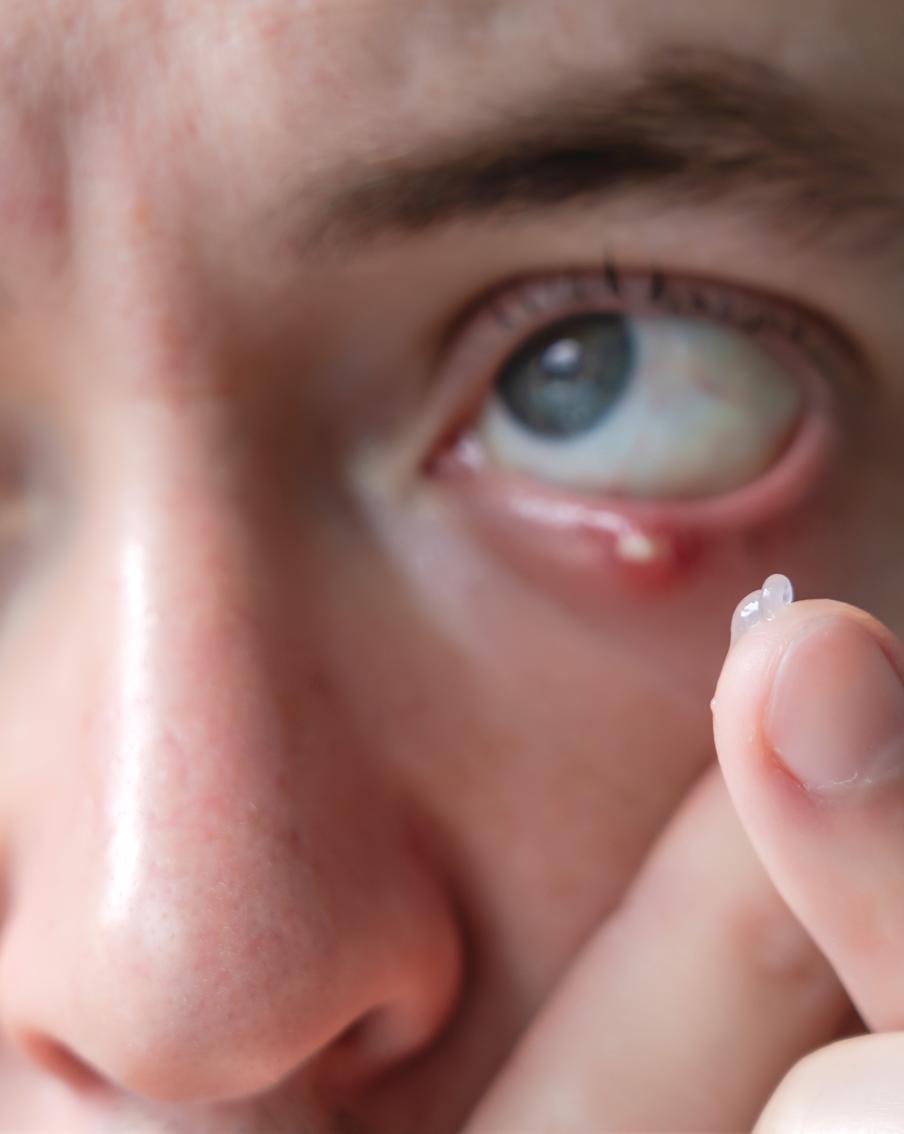 Ячмень на глазу – типичное заболевание для осени. Эксперт рассказал, как с ним бороться