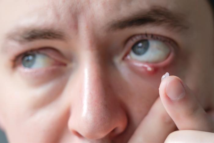 Ячмень на глазу – типичное заболевание для осени. Эксперт рассказал, как с ним бороться