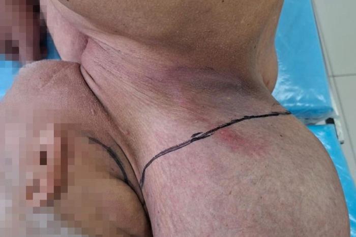 Житель Кирова отрастил "вторую голову" и был прооперирован – подобные случаи