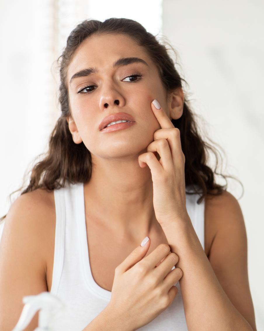 Прыщ накануне важного дня? Косметолог рассказывает, что делать