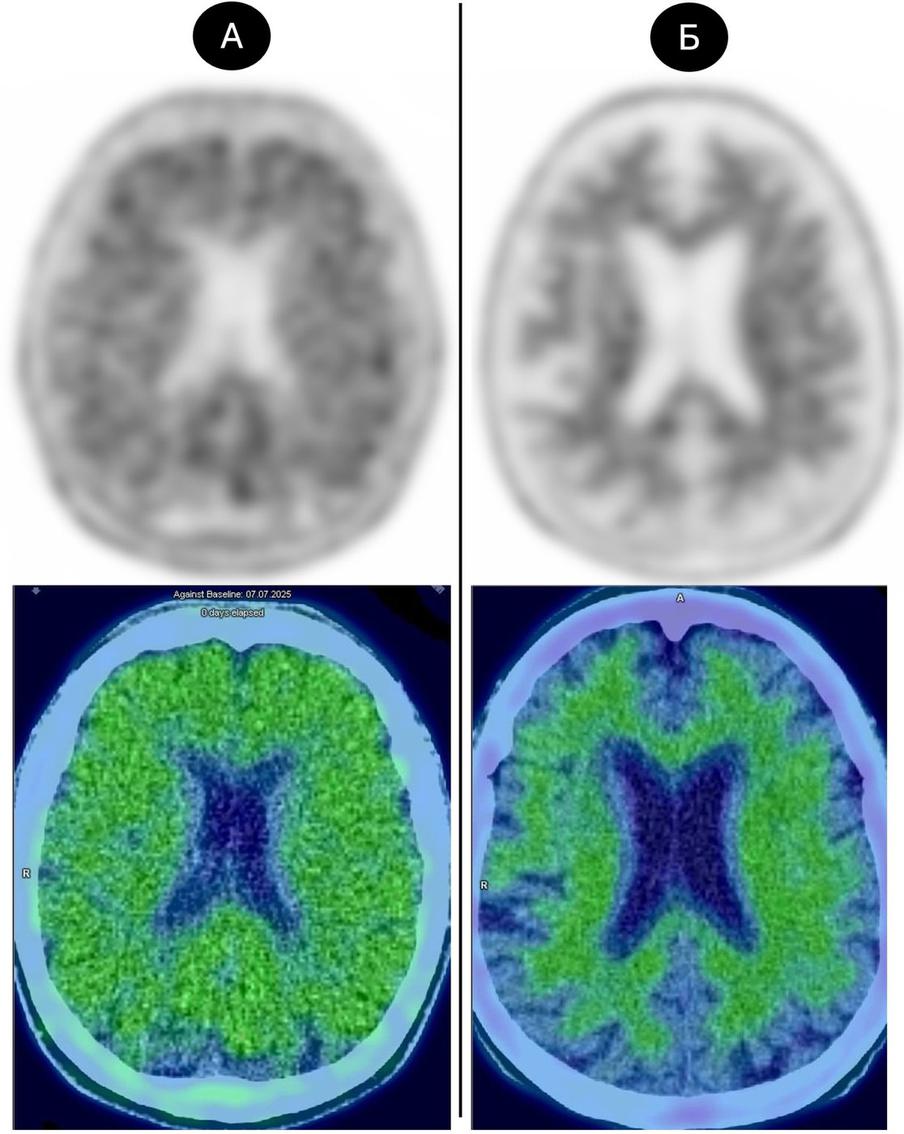 Результаты ПЭТ двух пациентов: слева с положительным результатом, справа – с отрицательным.