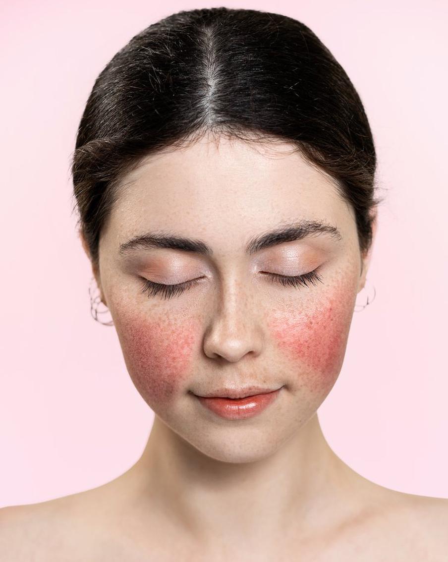 Как ухаживать за кожей с куперозом зимой: рекомендации эксперта