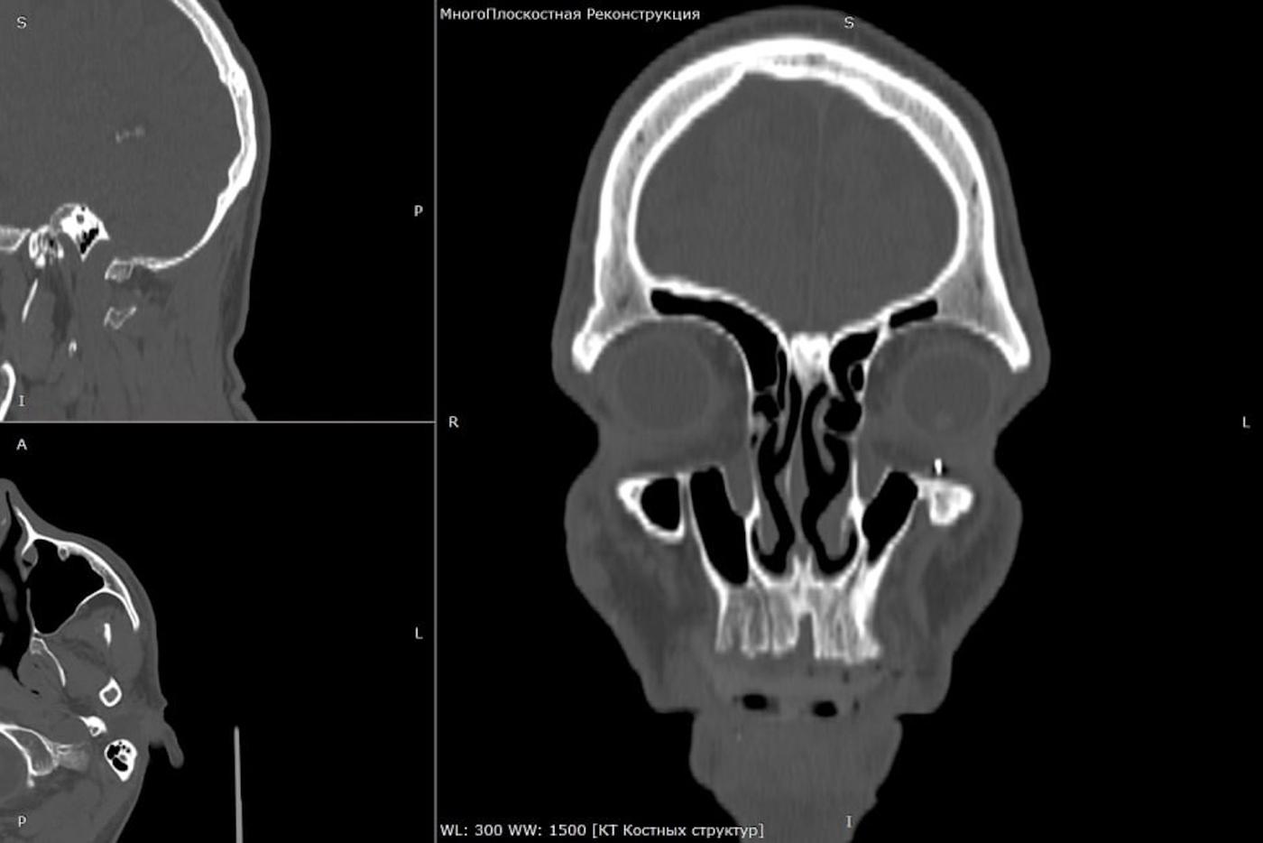 "Снайпер пробил глаз": в Подмосковье спасли зрение бойцу СВО