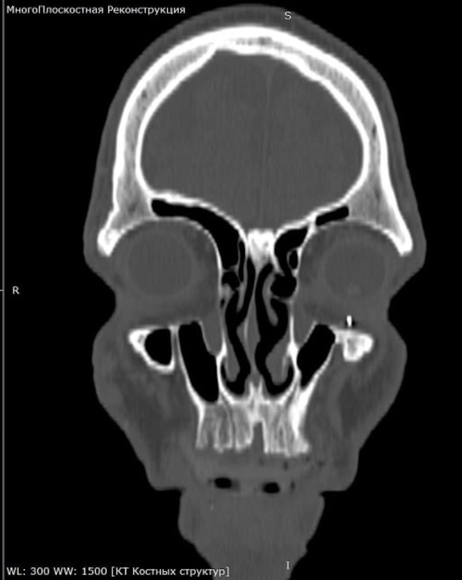 "Снайпер пробил глаз": в Подмосковье спасли зрение бойцу СВО