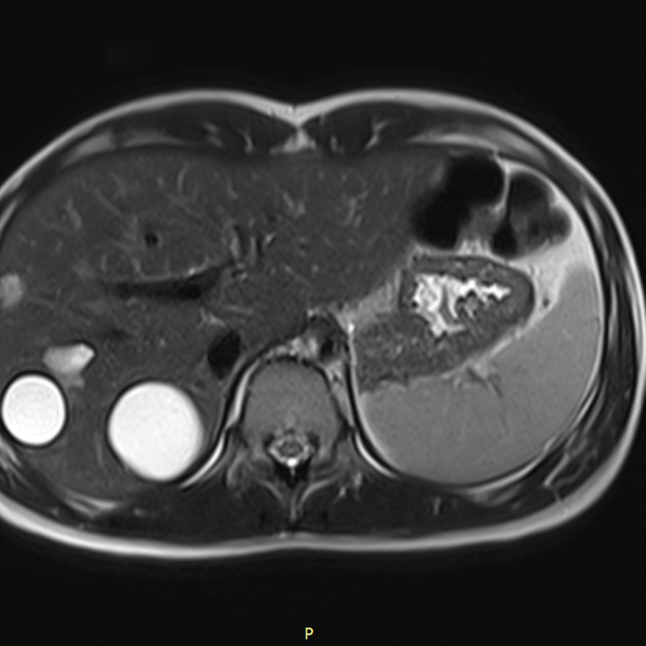 Кисты в печени пациентки.