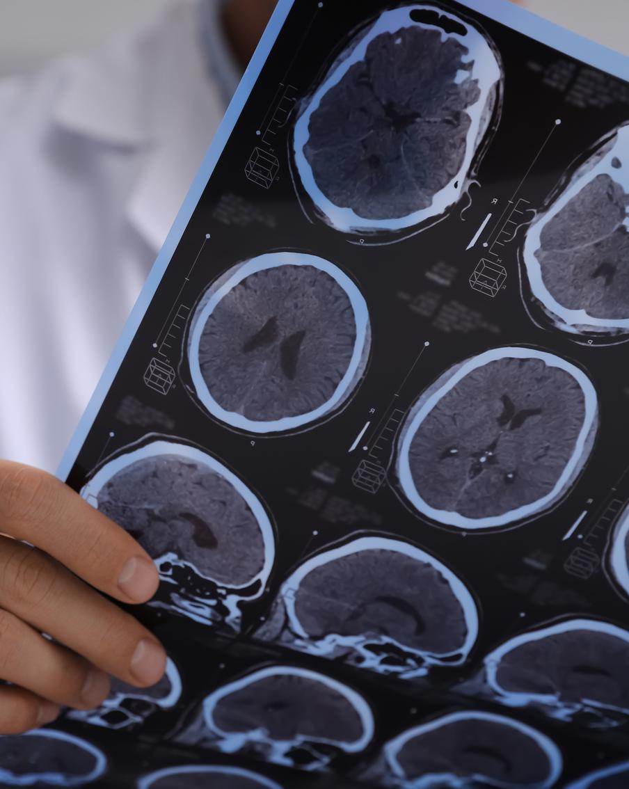 Почему ранняя диагностика важна для больных рассеянным склерозом