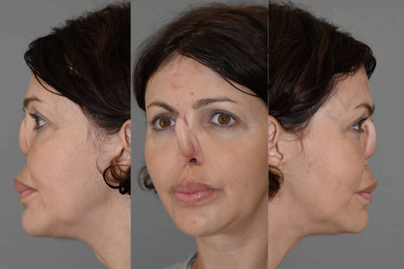 Алиса Аршавина после неудачной пластики.