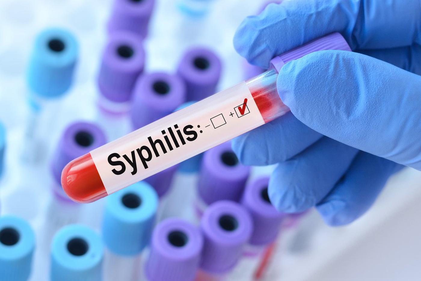 Сифилис в России пошёл в рост – статистика бьёт тревогу