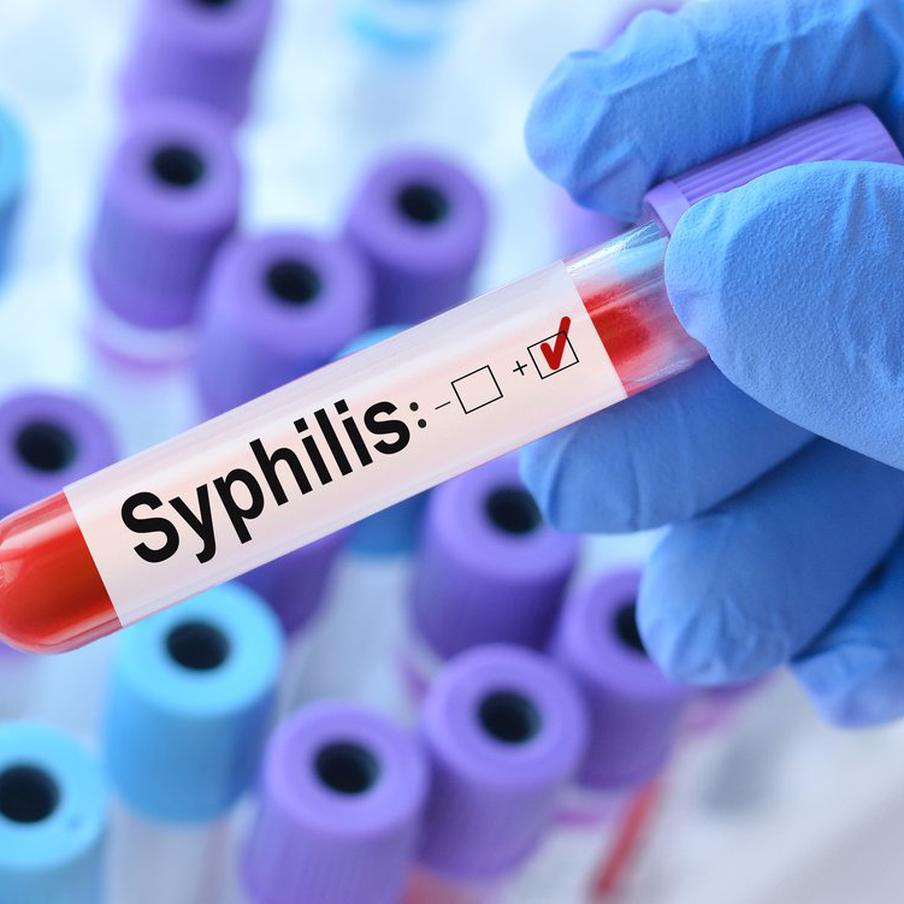 Сифилис в России пошёл в рост – статистика бьёт тревогу. За последние годы в стране резко увеличилось число случаев сифилиса, несмотря на общее снижение других ИППП. Эксперты называют несколько причин происходящего и предупреждают о скрытых рисках