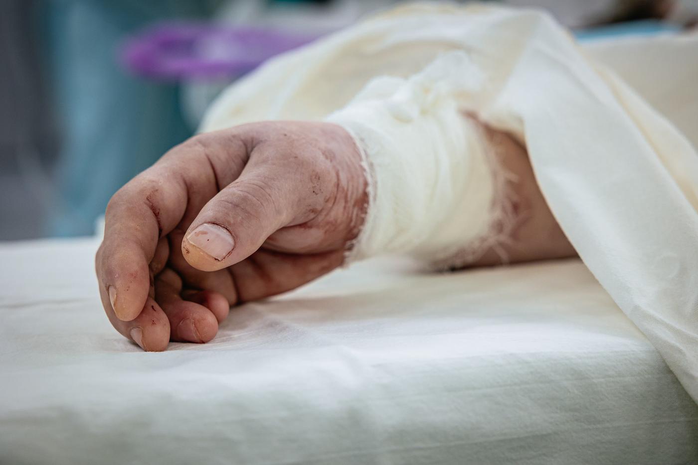 Пересаженная кисть