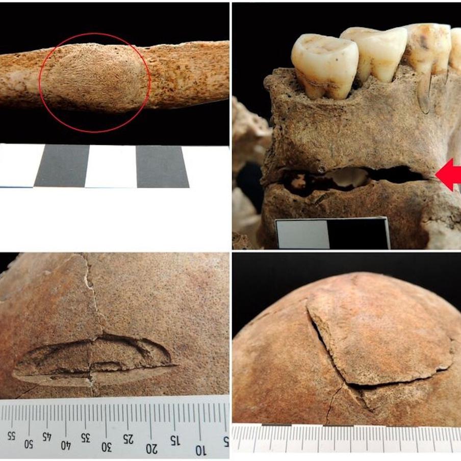 Все травмы, полученные "вампиром" при жизни.
