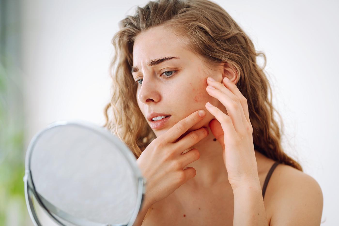 Аллергия или дерматит: как распознать и как успокоить раздражённую кожу