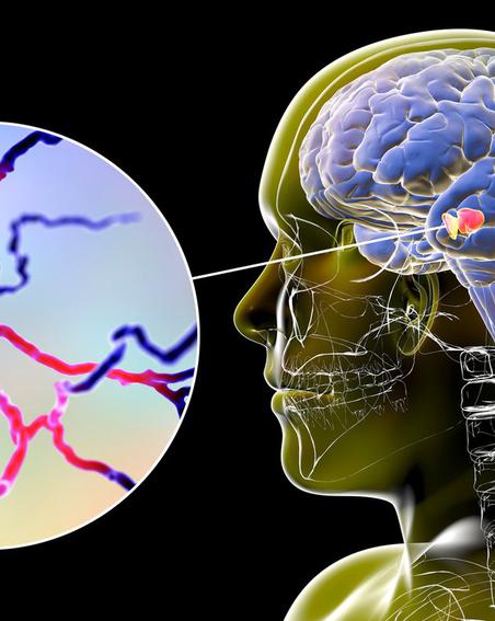 Японцы создали чудо-таблетку от болезни Паркинсона
