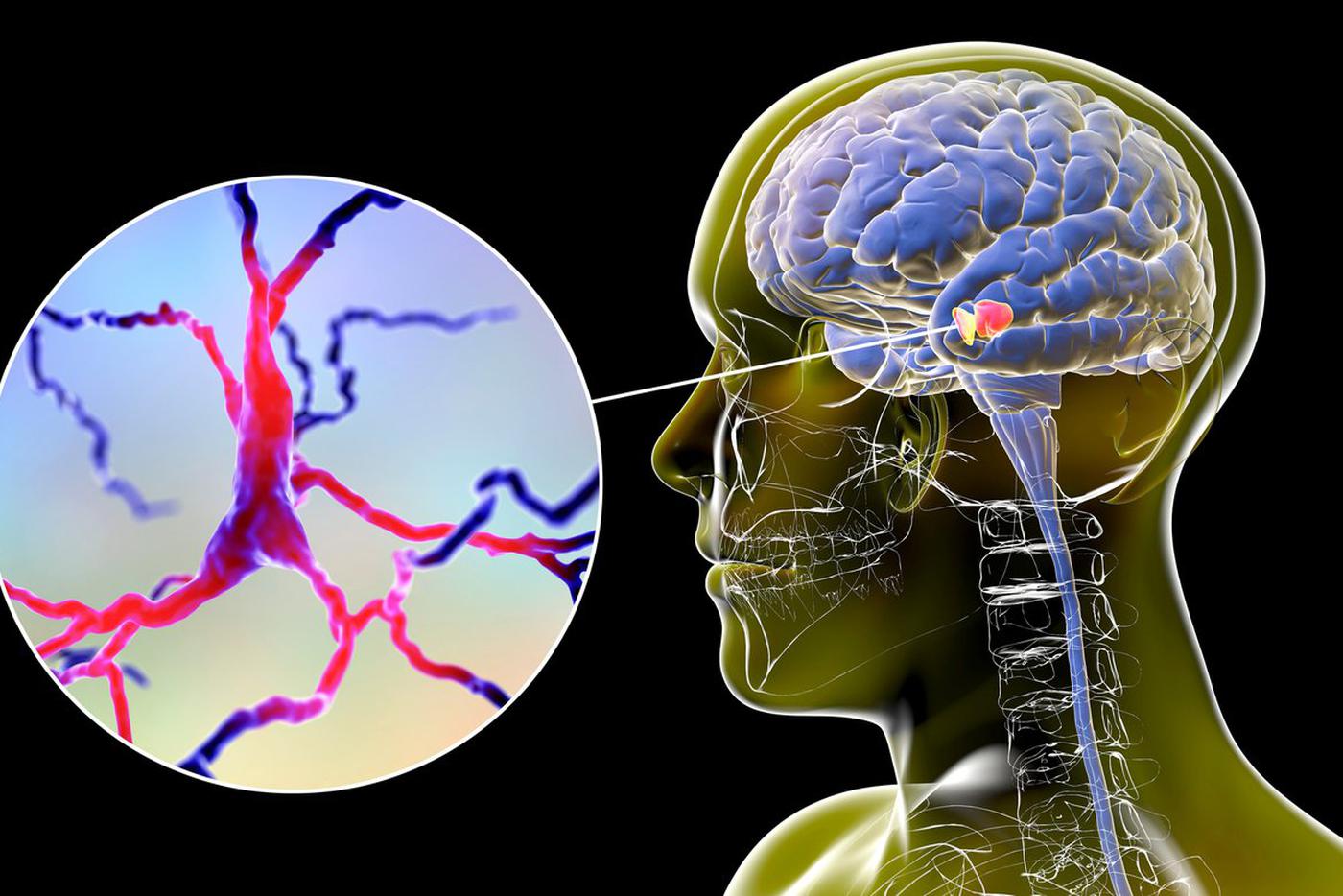 Японцы создали чудо-таблетку от болезни Паркинсона