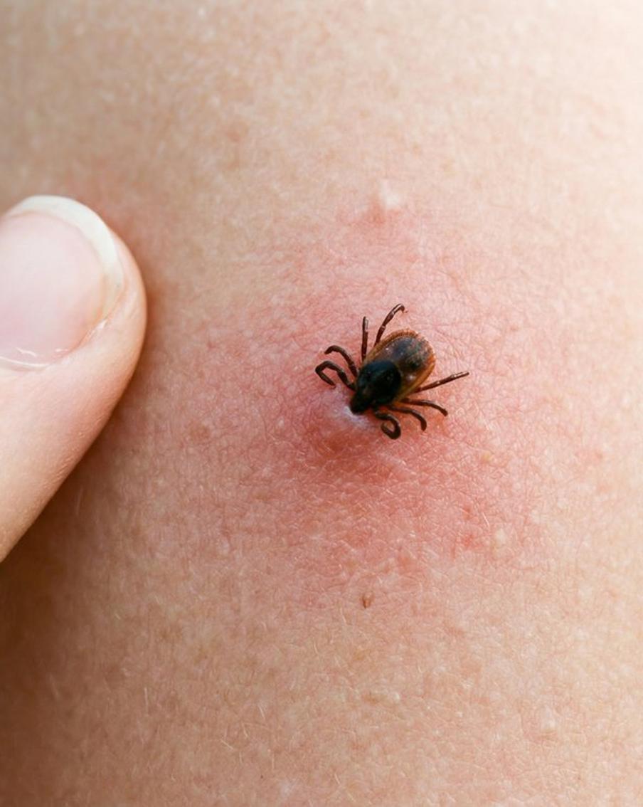 Роспотребнадзор предупредил: укус клеща невозможно почувствовать. Единственный способ обнаружить, что кровосос уже впился в тело, — это найти его визуально. Специалист ведомства также развенчала миф о существовании стопроцентной защиты от членистоногих
