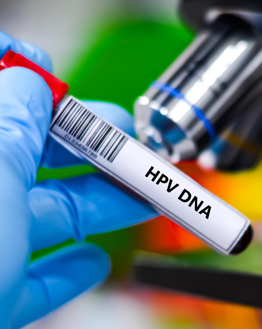 Анализ на ВПЧ включили в первый этап диспансеризации для россиянок. Женщины от 21 до 49 лет теперь смогут проходить тестирование на вирус папилломы человека высокого канцерогенного риска в рамках профилактических осмотров. При положительном результате исследования будут проводиться ежегодно