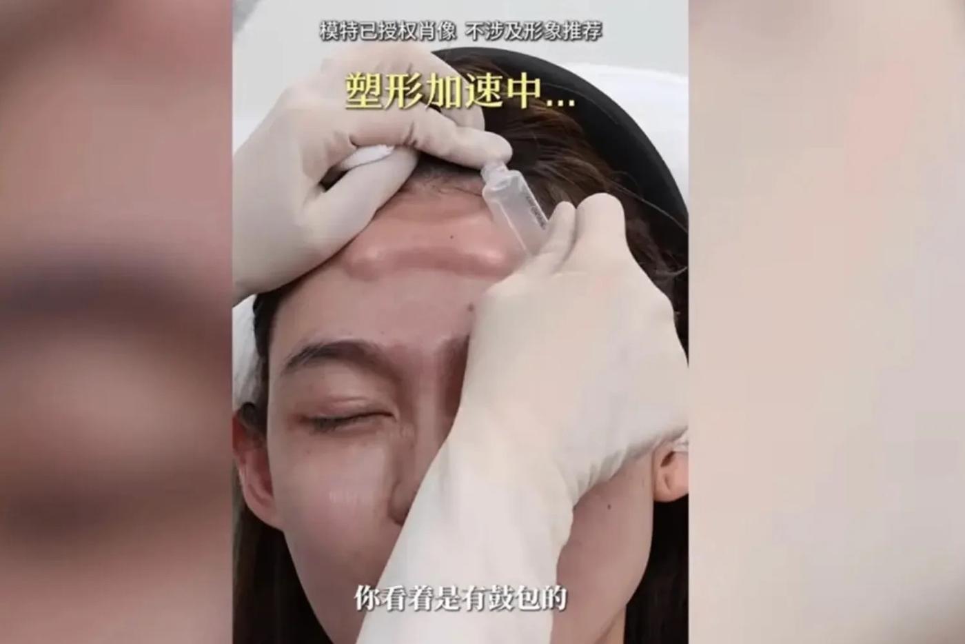 В китайских соцсетях вирусятся видео, на которых филлер, будто пластилин, раскатывают по лбу.